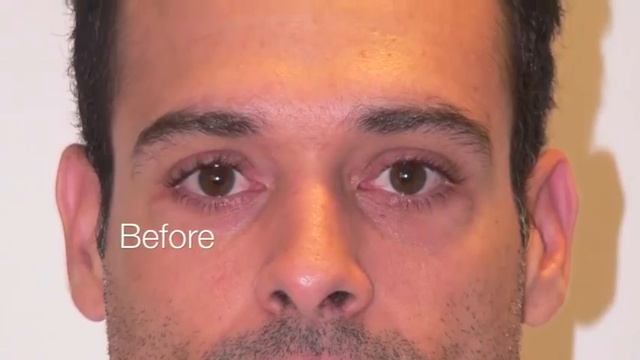 Transplante de Pelo Eric T. Adler, MD смотреть онлайн