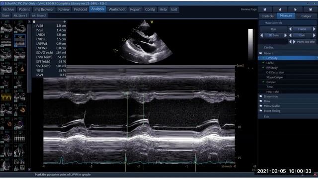 Эхокардиография для начинающих, на примере данных, собранных для Рабочей станции. Вебинар 05.02.21 смотреть онлайн