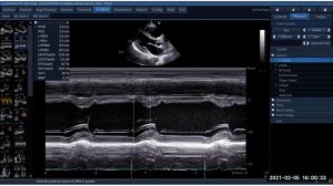 Эхокардиография для начинающих, на примере данных, собранных для Рабочей станции. Вебинар 05.02.21