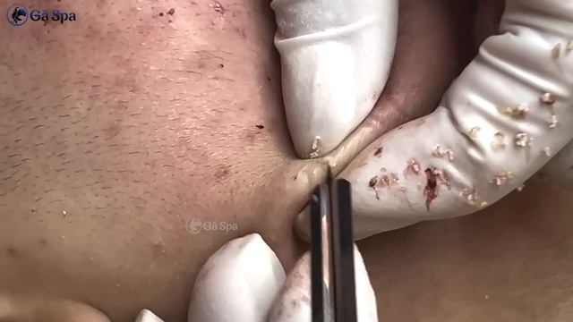 Relaxing Acne Treatment |Acnes Treatment смотреть онлайн