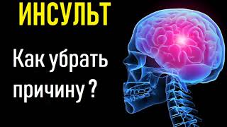 Инсульт головного мозга. Причина инсульта, восстановление, лечение, профилактика смотреть онлайн