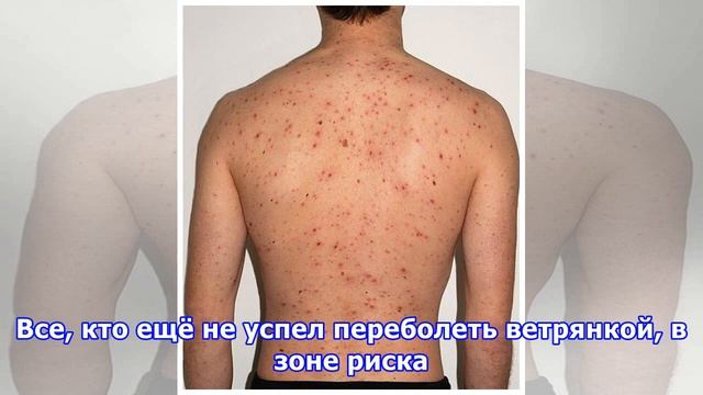 Можно ли заболеть ветрянкой во второй раз смотреть онлайн