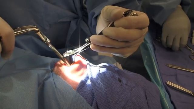 Septoplasty (GRAPHIC) - Deviated Septum Surgery