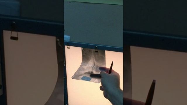 Sinusitis, Polyps & Epistaxis with X-Ray смотреть онлайн