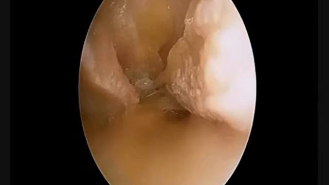-FOGGING - How to Address Fogging During Endoscopic Carpal Tunnel Release.wmv смотреть онлайн