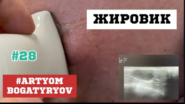 28. ЖИРовик, удаление и косметический шов