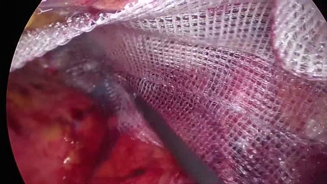 Трансабдоминальная преперитонеальная пластика (TAPP) косой паховой грыжи