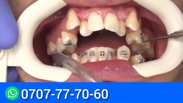 Стоматология Бишкек 0552-73-73-73 WhatsApp смотреть онлайн