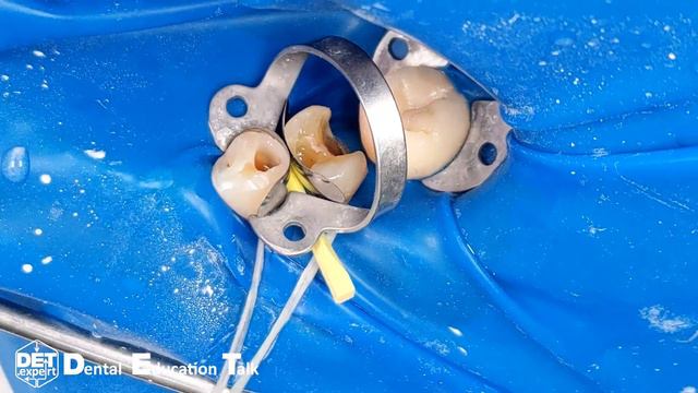Изоляция зубов 34,35 класс-II, якорный кламп на коронке с имплантом 36 DET.expert & Sanctuary 4K смотреть онлайн
