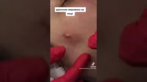 удаление жировика на лице