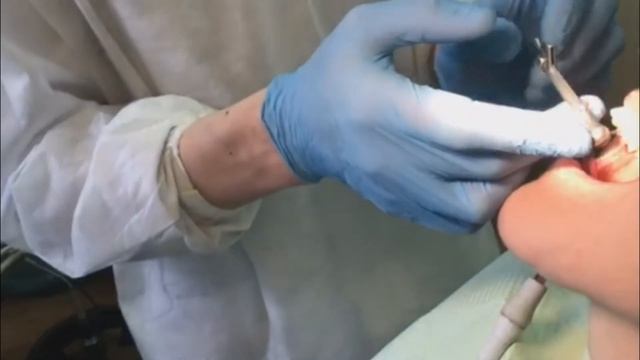 Пациентка"А". Протезирование 2.2. циркониевой коронкой на имплантате Megagen. 4-я стоматология. смотреть онлайн