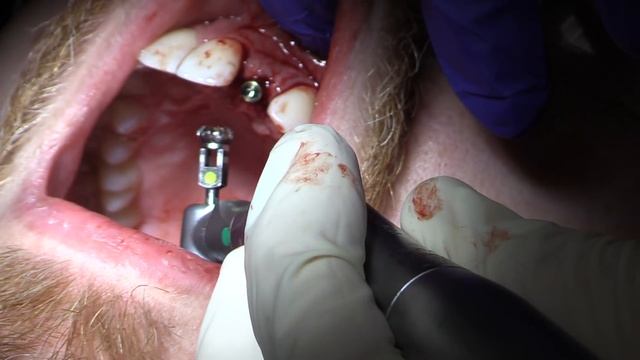 Bone Mill for the Conical Connection Implant from Nobelbiocare смотреть онлайн