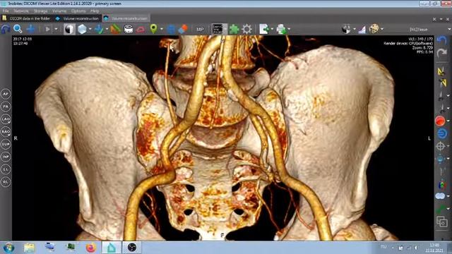 АРТЕРИИ . КОЛЛАТЕРАЛИ . смотреть онлайн