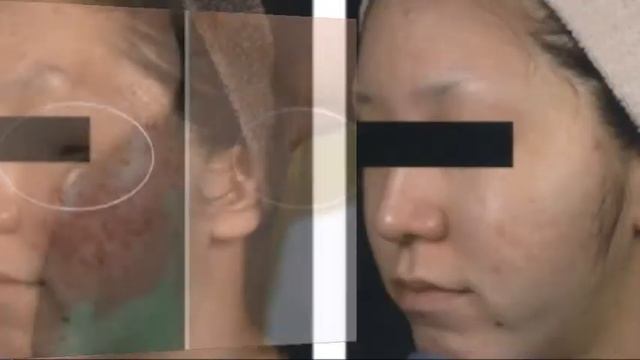 Endymed 3DEEP Lifting BEFORE & AFTER 1 смотреть онлайн