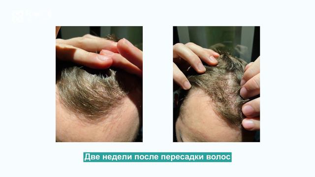 Год после пересадки. История пациента