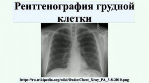 Рентгенография грудной клетки