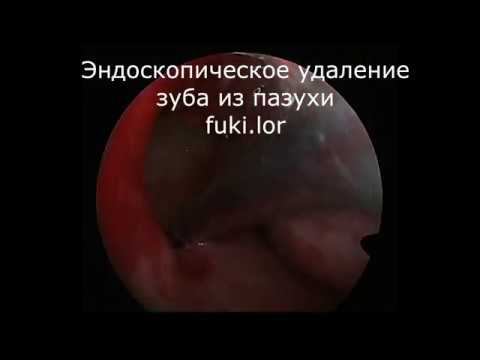 Эндоскопическое удаление зуба из пазухи, ЛОР-операция, оперирует лор к.м.н. Фуки Евгений Михайлович смотреть онлайн