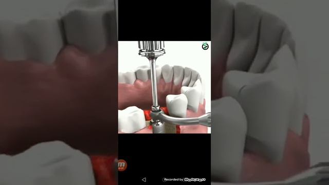Как Вот как надо поставить зуб смотреть онлайн
