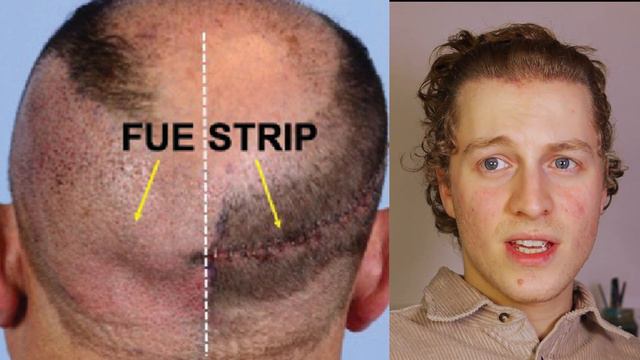How to Get 3,000 More Grafts From Your Donor Area смотреть онлайн