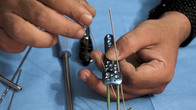 PHILOS Plate Fixation Procedure For Proximal Humerus Fracture