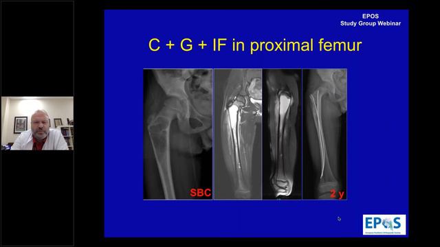 EPOS Study Group Webinar Bone Cyst Is it as simple as it looks смотреть онлайн