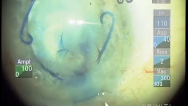 Malyugin Ring Fibrotic Capsule смотреть онлайн