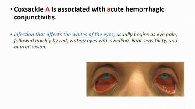COXSACKIE VIRUS Symptoms, Causes, Transmission, Treatment- Hand Foot Mouth disease- Herpangina смотреть онлайн