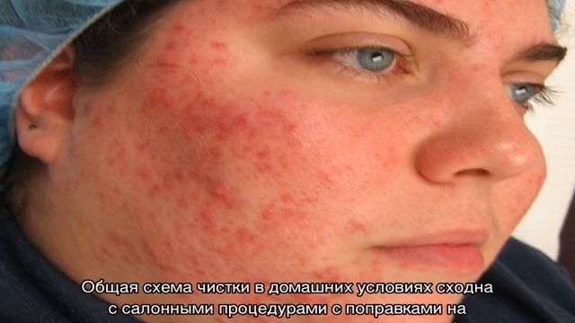 Чистка лица от угрей смотреть онлайн