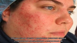 Чистка лица от угрей