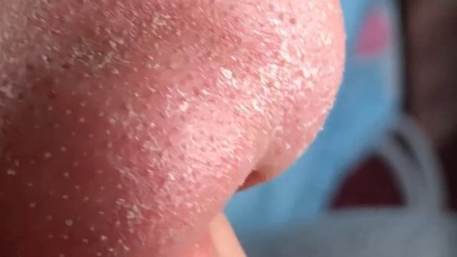 Прыщи / Огромные прыщи / Релакс с акне / Выдавливание прыщей / Черная точка  #Прыщи