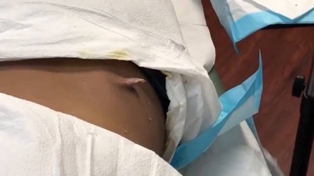 Удаляем гной на коже смотреть онлайн