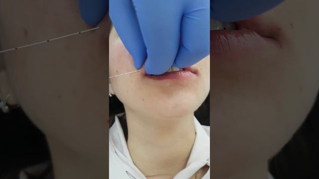 Контурная пластика губ. Увеличение губ с помощью атравматической канюли.