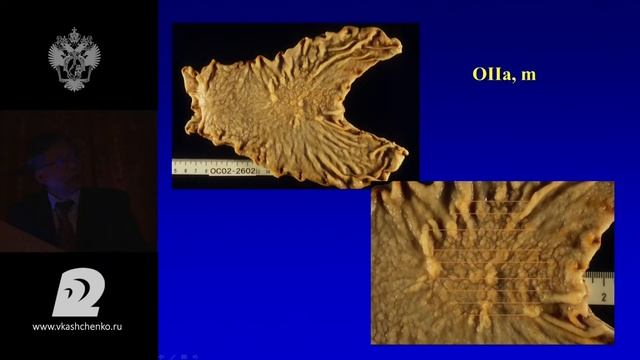 Shimoda Ранний рак желудка