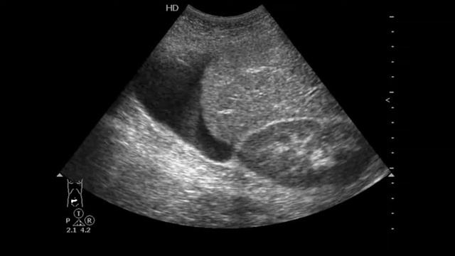 Кровь в брюшной полости. Blood in peritoneal space смотреть онлайн