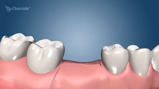 Dental Implant Procedure - Two Stage ? Award Winning Patient Education смотреть онлайн