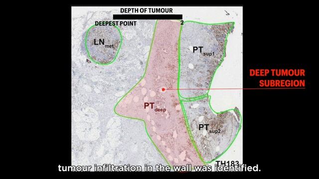 Spatial profiling of gastric cancer metastases reveals principles of tumour dissemination смотреть онлайн