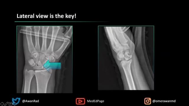 MSK CASE #97- How To Make Sense Of Carpal Instability In The Wrist? смотреть онлайн