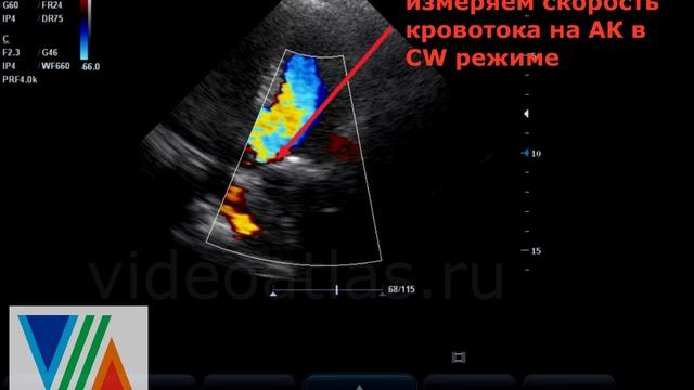 Подклапанный стеноз Ао смотреть онлайн