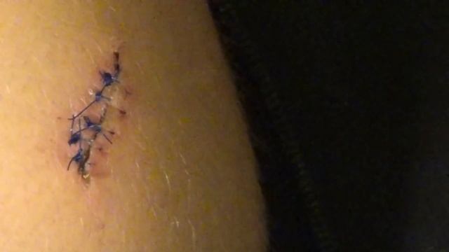 REMOVING MY STITCHES!!! - FULL PROCEDURE смотреть онлайн