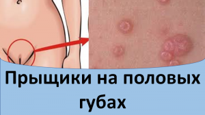 Прыщики на половых губах.
