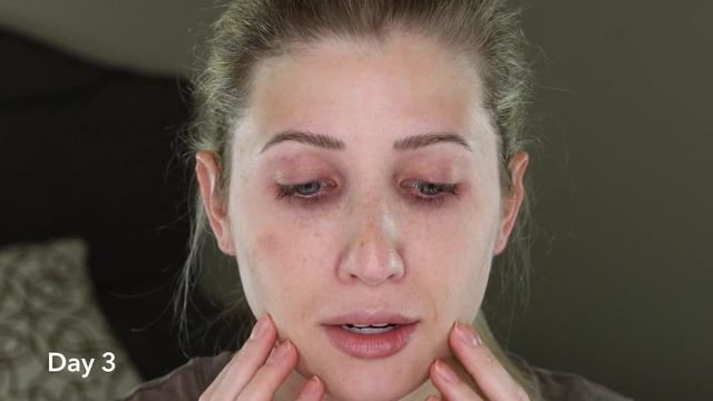 My CHEMICAL PEEL Experience // JESSNER Chemical PEEL смотреть онлайн