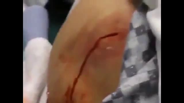 Squeeze Acne: PUS FILLED INFECTION IS DRAINED Squeeze Acne