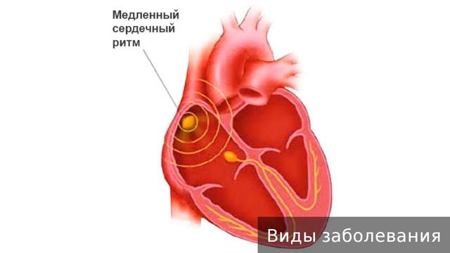 Брадикардия. Как лечить брадикардию.