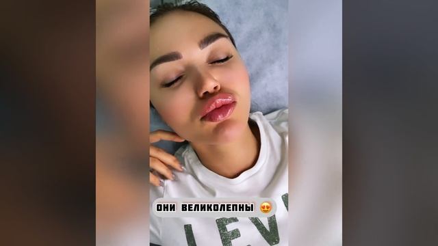 Филлер Stylage M. Какой выбрать филлер для увеличения губ. Как делают увеличение губ филлером. смотреть онлайн