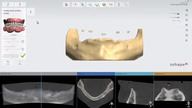 3Shape Implant Studio - Bone-supported guide смотреть онлайн