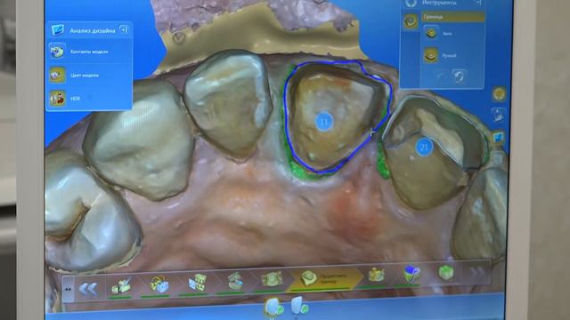 Протезирование на немецком оборудовании CEREC, с применением компьютерной технологии смотреть онлайн