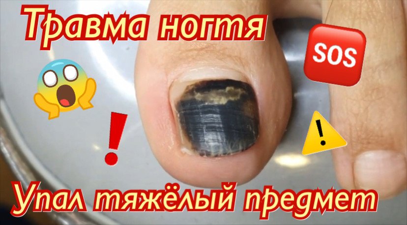 Травмированный ноготь⚠️????