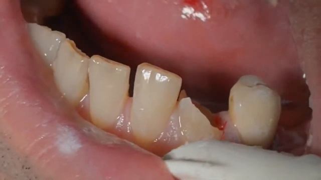 Передняя эстетическая керамика Cerec V Prep против коронки PAG смотреть онлайн