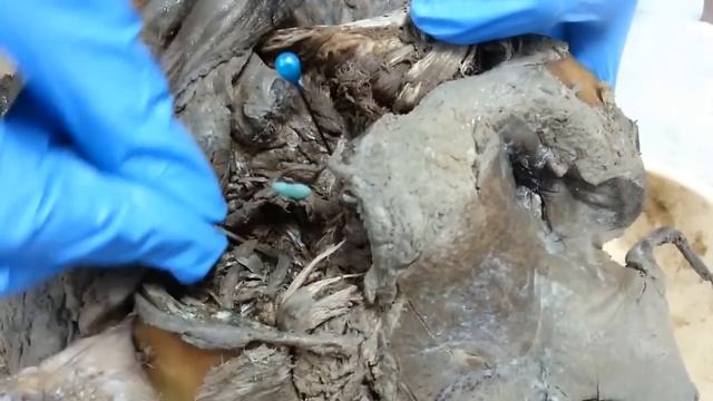 GIT anatomy revision l Part Two AMSP 2018 смотреть онлайн