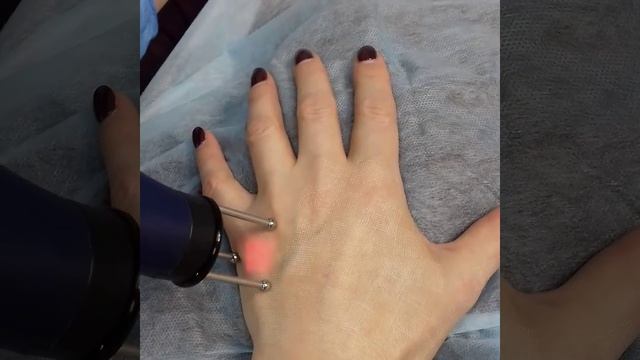 Лазерный пилинг рук. Омоложение рук с помощью эрбиевого лазера MCL 31 Dermablate. смотреть онлайн